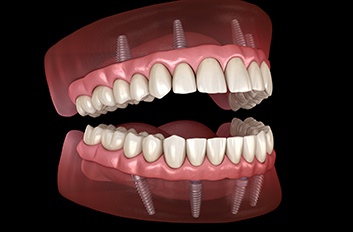 Illustration of All-on-4 implants for upper and lower dental arches
