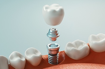 Illustration of traditional dental implant, abutment, and crown