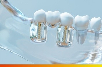 Model of dental implants in Brooklyn