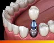 Animated dental implant with dental crown replacing a missing tooth