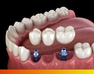 Animated dental implant bridge replacing three missing teeth