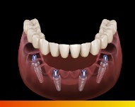 Animated implant denture replacing a full row of teeth