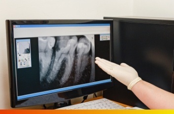 Gloved hand gesturing to computer screen showing digital dental x rays