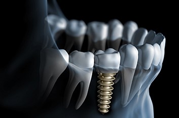 Digital illustration of dental implant