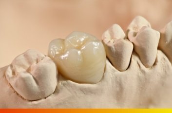 Dental crown on model of tooth