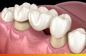 Animated dental bridge replacing a missing tooth