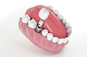 a 3D depiction of a single dental implant
