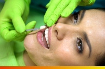 Dentist placing a veneer over a woman's tooth