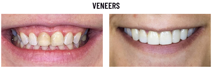 Before and after photos of dental veneers: the left image shows discolored, uneven teeth, while the right image shows straight, white teeth with a bright smile.