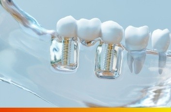 Dental model displaying two metal implants supporting artificial teeth in a transparent gum structure. Bright, clinical tone with a modern feel.